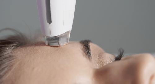 Hydrafacial Bielefeld Ergebnis